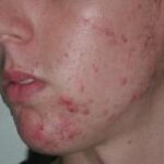 Acne Before Treatment