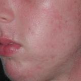 Acne After Treatment