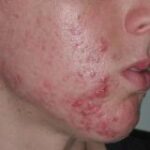 Acne Before Treatment