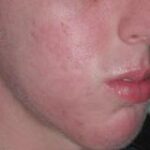 Acne After Treatment