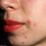 Acne before treatment