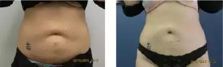 Fat Freezing Before and After